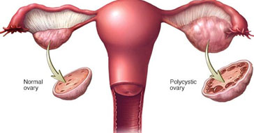 Polycystic Ovary Syndrome