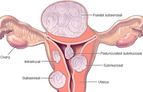 Uterine Fibroids