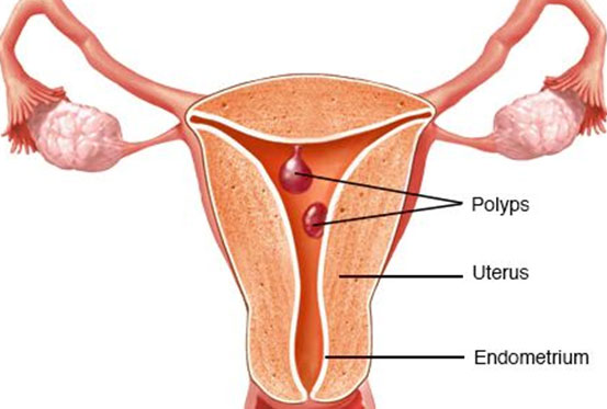 Uterine Polyps